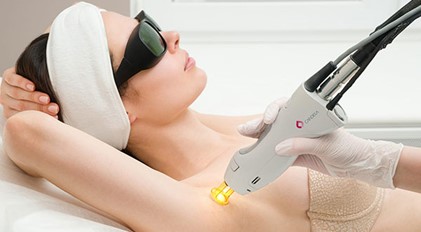 Candela Alexandrite Laser: Full Bikini + Underarms, only 60 euros