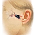 Starkey Soundlens - The smallest hearing aid in the world
