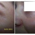 Wrinkles of the lower eyelid