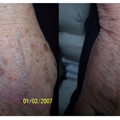 Laser spot treatment