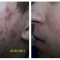 Photodynamic acne treatment