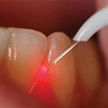 Teeth Laser Treatments
