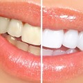 Teeth whitening