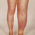 Leg Lymphedema