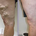 Repair of Varices