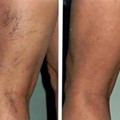 Repair of Telangiectasias