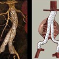 Intraluminal Repair of Aortic Aneurysm