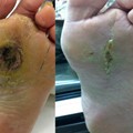 Foot Ulcer - Repair