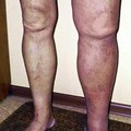 Venous Leg Thrombosis