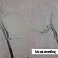 Carotid Angioplasty - Stenting
