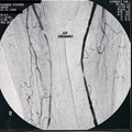 Atheromatosis of Arteries