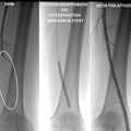 Angioplasty of the Femoral Artery