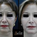 Υαλουρονικό οξύ