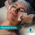 Θεραπεία ακμής