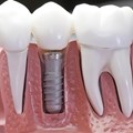 Dental implants