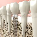 Implant