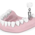 Implants
