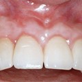 Reconstruction in the event of an accident with implants & bone grafts