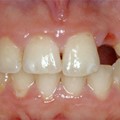 Prosthetic grafts