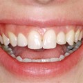 Placement of implants & gingival plastic surgery