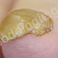 Onychogryphosis (thick, hard nails)