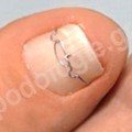Nail correction, the solution to nail penetration into the skin (onychocryptosis)