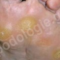 Skin hardening, metatarsal calluses