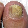 Nail fungi, alternative treatment with the Pact med method