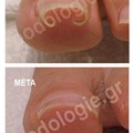 Restoration of nail penetration into the skin with nail correction brackets and plates