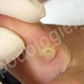 Cleaning of interdigital callus