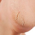 Skin hardening, heel hyperkeratosis with deep stretch marks