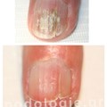 Alternative treatment of onychomycosis after 3 months, with the photodynamic Pact med equipment