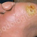 Treatment of ulcer on a diabetic foot