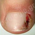 Nail penetration into the skin with inflammation, redness and swelling