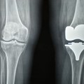 Knee replacement surgery