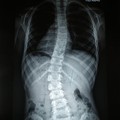 Scoliosis