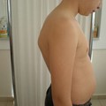 Kyphosis