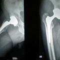 Hip replacement surgery