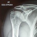Calcific Supraspinatus Tendinitis