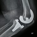 Knee replacement surgery