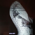 Thoracic Kyphosis