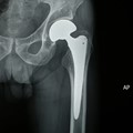 Hip replacement surgery