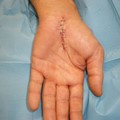 Carpal Tunnel Syndrome