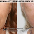 Αναίμακτο lifting με νήματα 6D