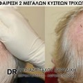 Χειρουργική αφαίρεση 2 μεγάλων κύστεων τριχωτού κεφάλης