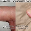 Χειρουργική αφαίρεση καρκινώματος στο υπονύχιο