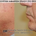 Χειρουργική αφαίρεση σπίλου στο πρόσωπο