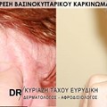 Χειρουργική αφαίρεση βασικοκυτταρικού καρκινώματος πτερυγίου