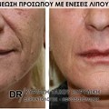 Ανανέωση προσώπου με ενέσεις λίπους