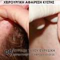 Χειρουργική αφαίρεση κύστης